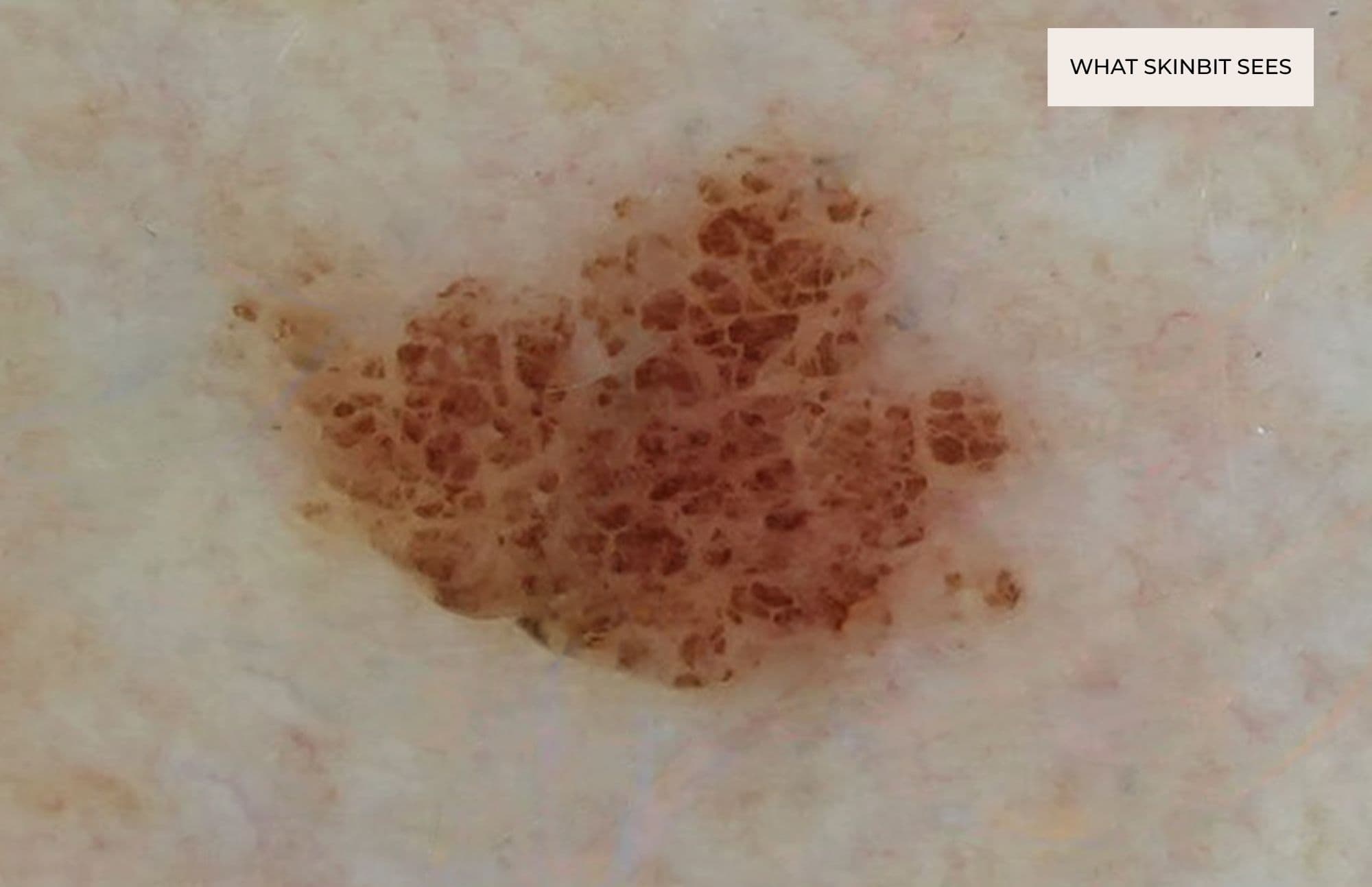 Magnified dermoscopic image of a pigmented skin lesion, illustrating the level of detail captured by SkinBit imaging technology