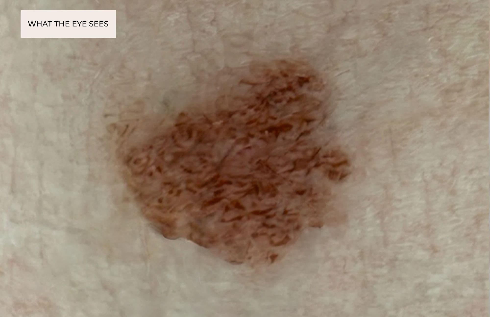 Magnified dermoscopic image of a pigmented skin lesion, illustrating the level of detail of what the naked eye sees